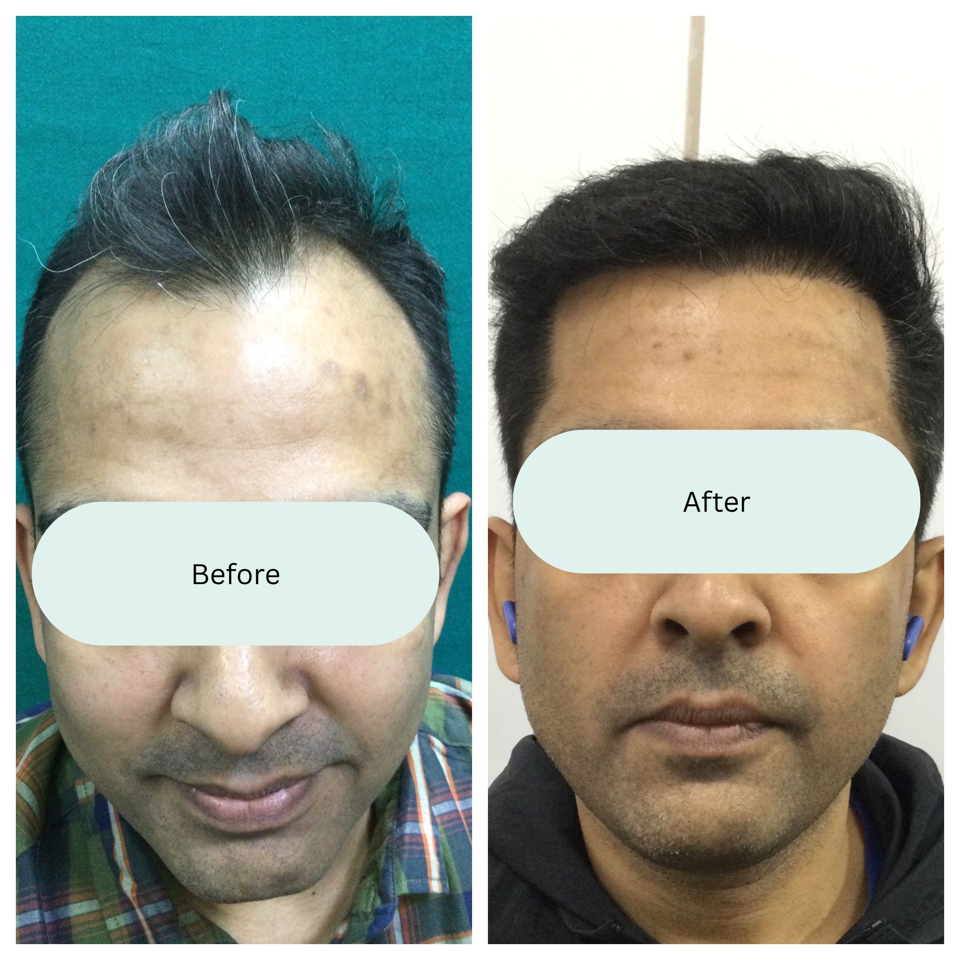 Before and after result