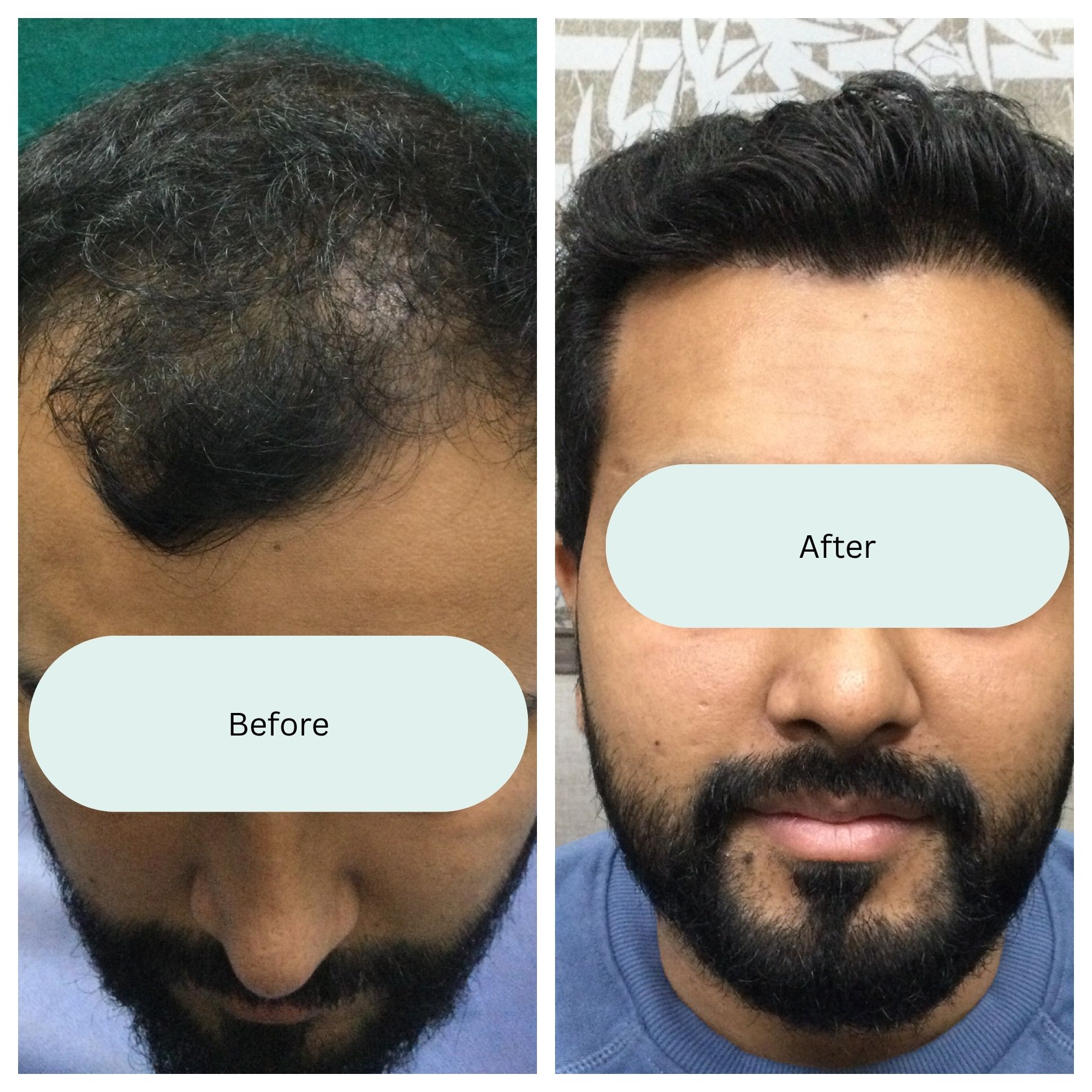 Before and after result