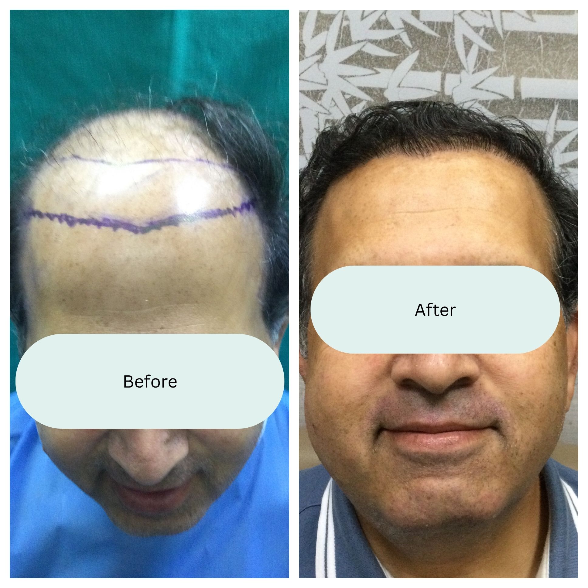 Before and after result